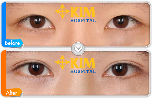 Khách hàng chia sẻ ý kiến về bấm mí mắt tại bệnh viện Kim 1
